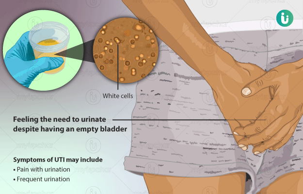 Urinary Tract Infection (UTI): Causes, Symptoms, and Treatment